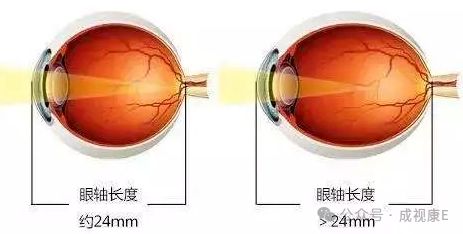 高度近视人群这几条内容务必知道！凯时尊龙人生就是博【爱眼小课堂】(图3)